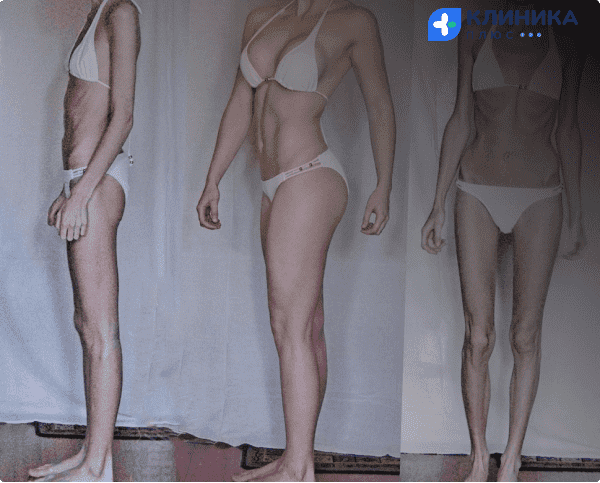 3 фото, анорексия  и не анорексия 